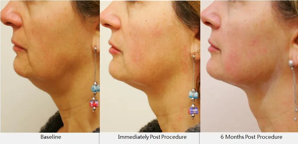 Before and After Results