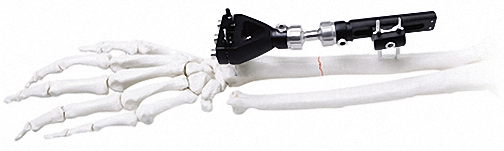Versatile External Fixator for Bone Fixation, White &amp; Black Stainless Steel