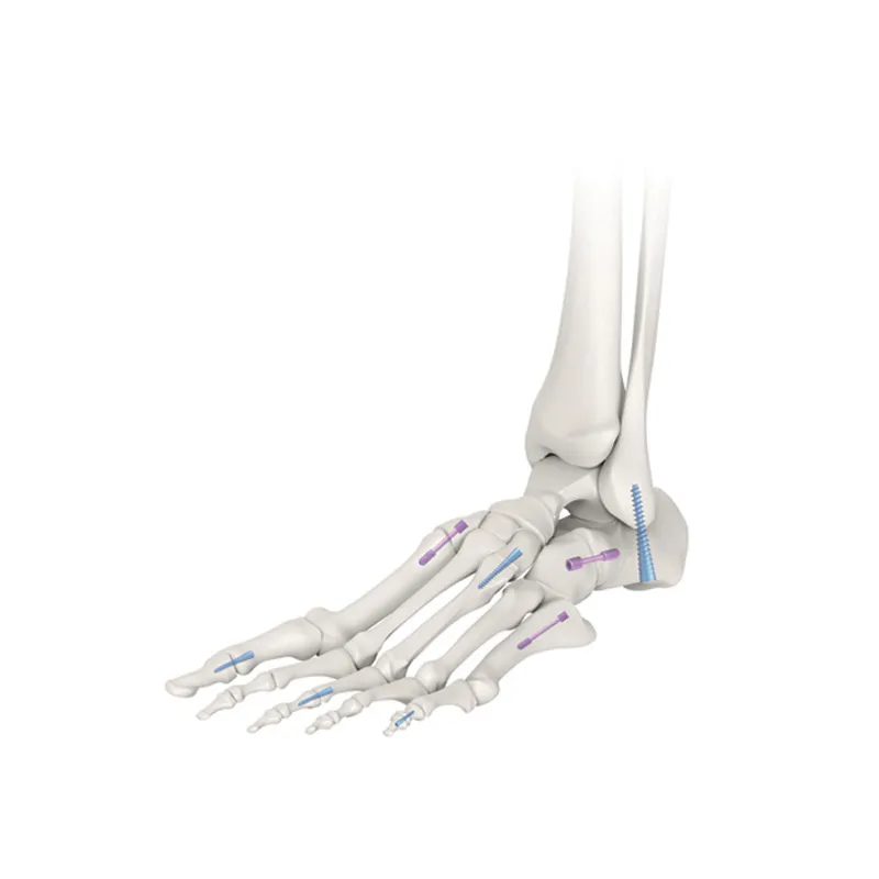 Orthopedic Implant Product 1