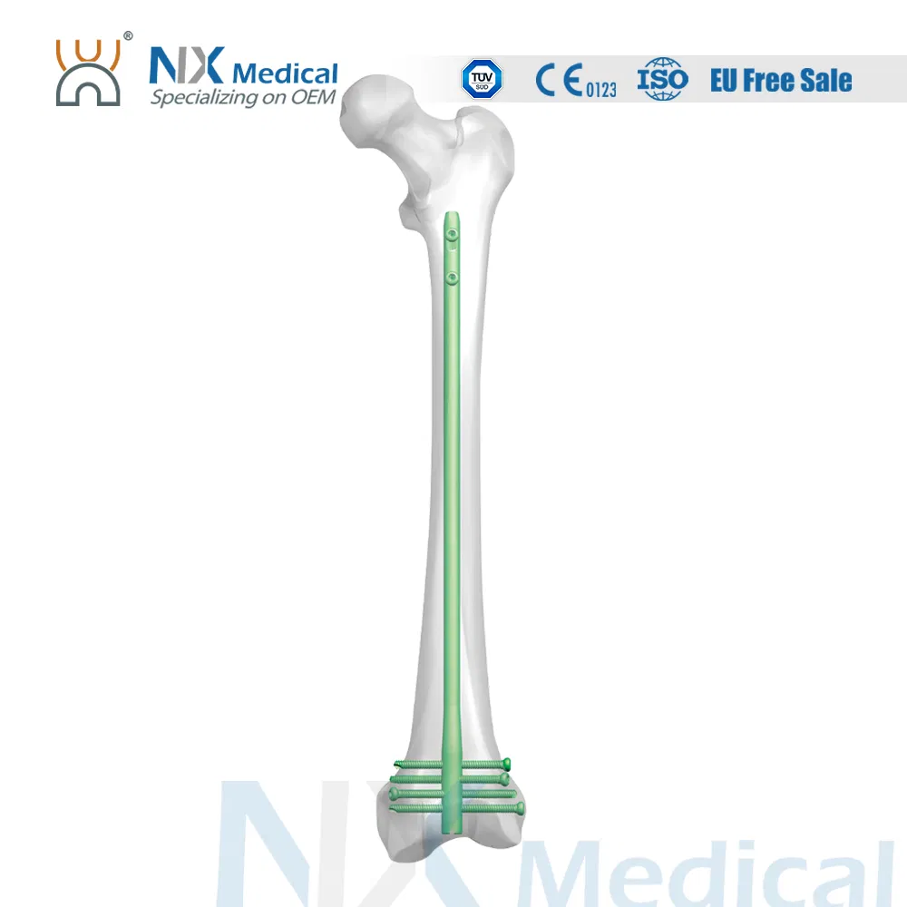 Nx Medical Retrograde Titanium Femoral Intramedullary Interlocking Nail System for Orthopedic Implants