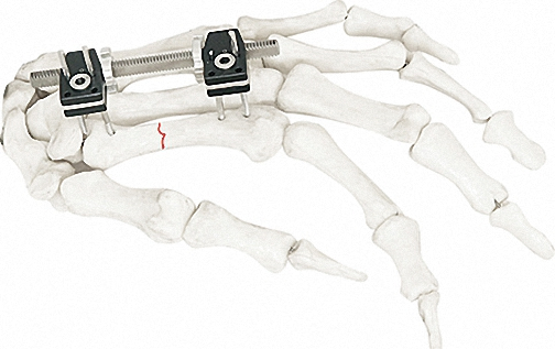 Versatile External Fixator for Bone Fixation, White &amp; Black Stainless Steel