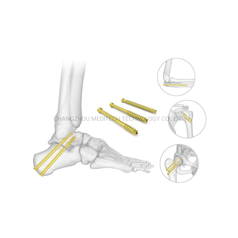 Orthopedic Implants Titanium Medical Bone Screws Cannulated Screw Partially-Threaded