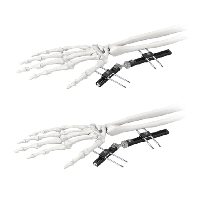 CE Certified Ilizarov External Fixator with Foot Ring for Foot &amp; Ankle Trauma