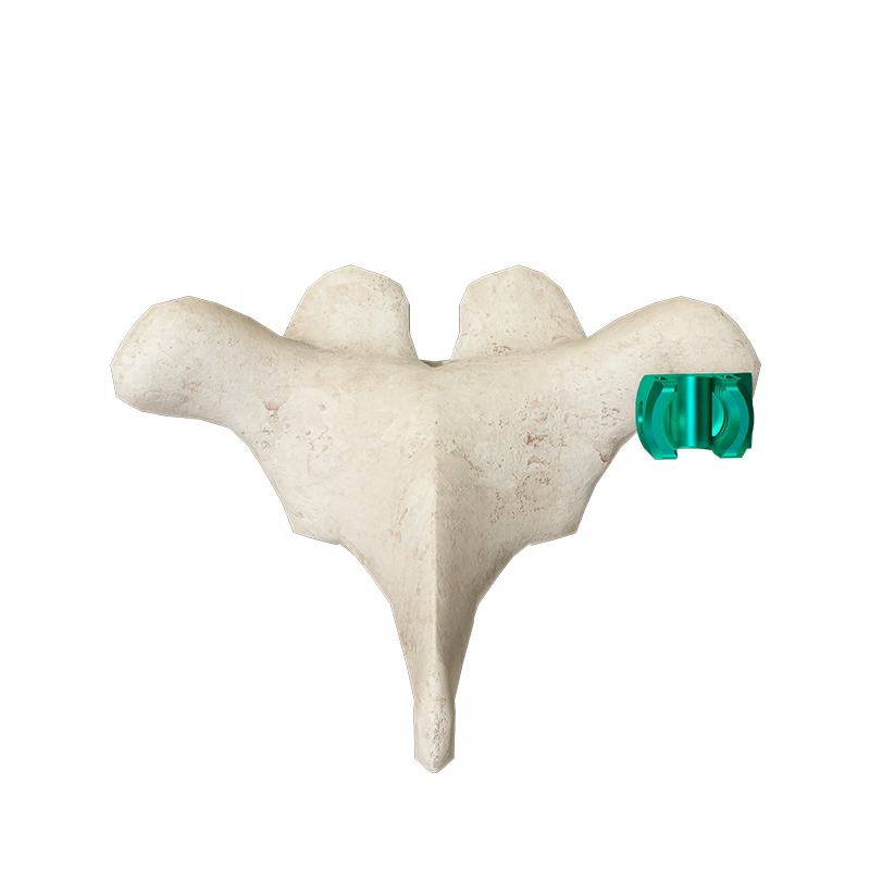 Pediatric Bone Density Fixation System Spinal Hook for Safe Vertebral Support