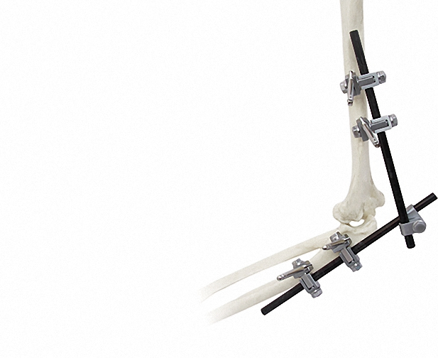 Versatile External Fixator for Bone Fixation, White &amp; Black Stainless Steel