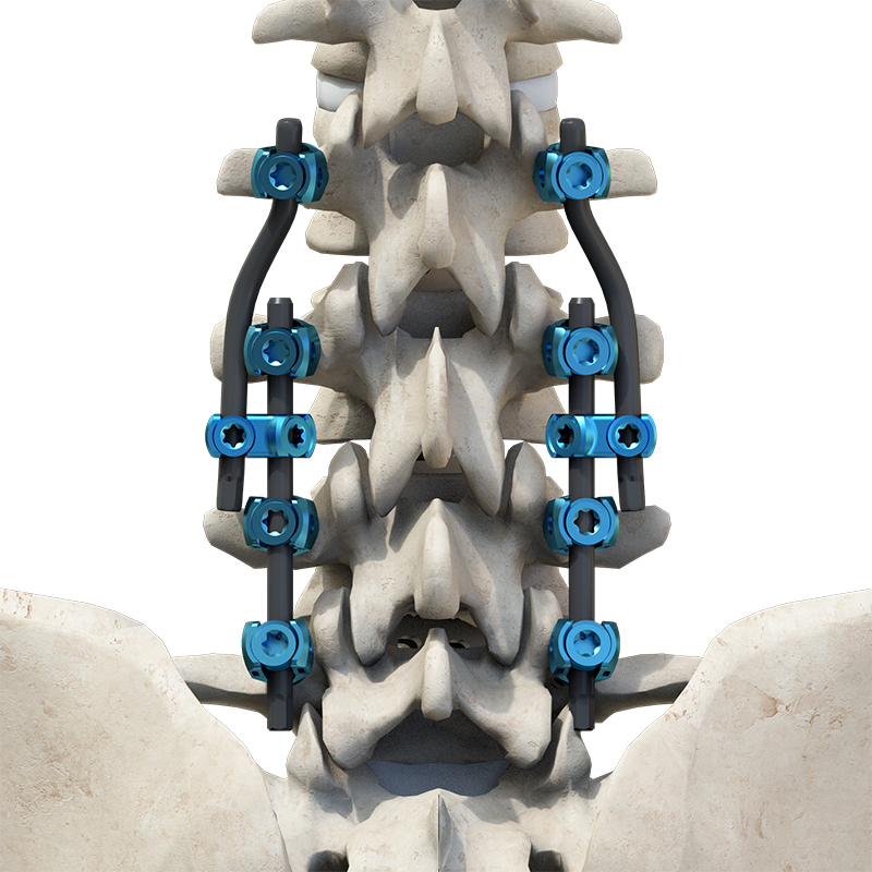 High-Strength Cocrmo Thoracolumbar Pedicle Screw and Rod System
