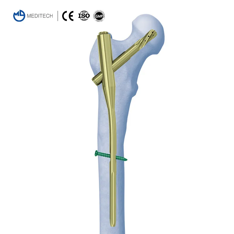 Femoral Interlocking Nail