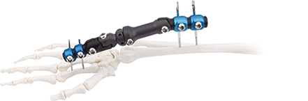Orthopedic Wrist External Fixator (Radiolucent multi-joint) type)