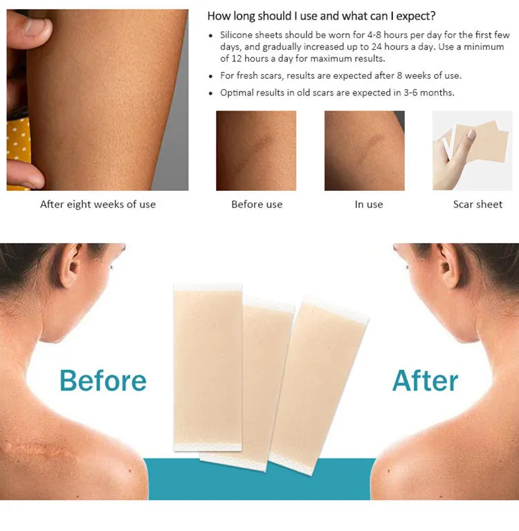 Silicone Scar Sheet 5