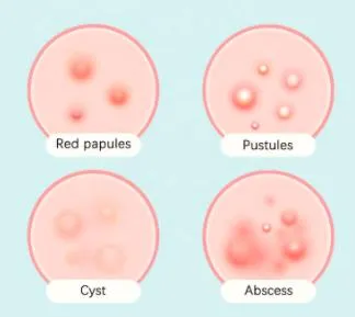 Acne Patch Product View 4