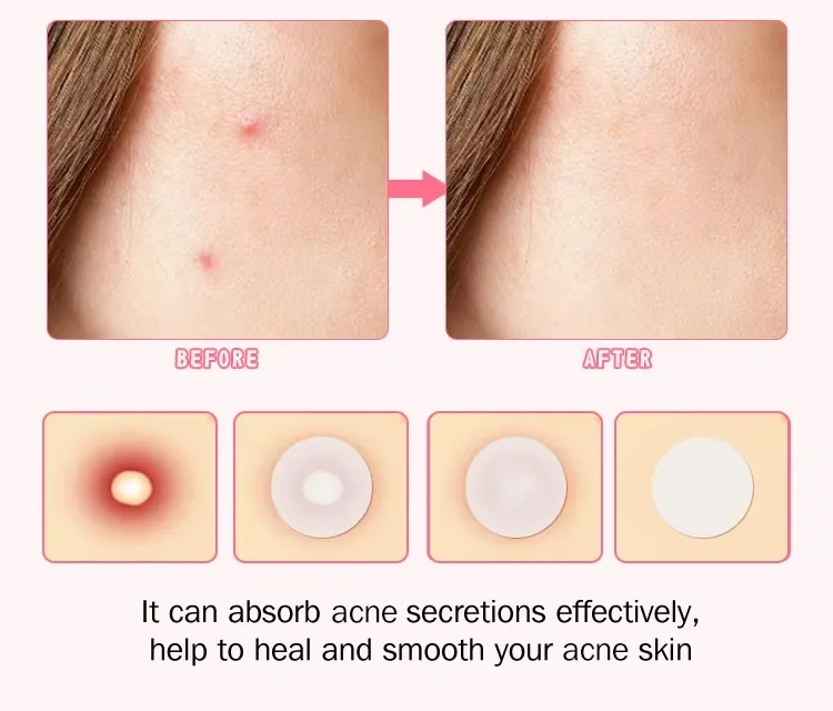 Waterproof Pimple Patches