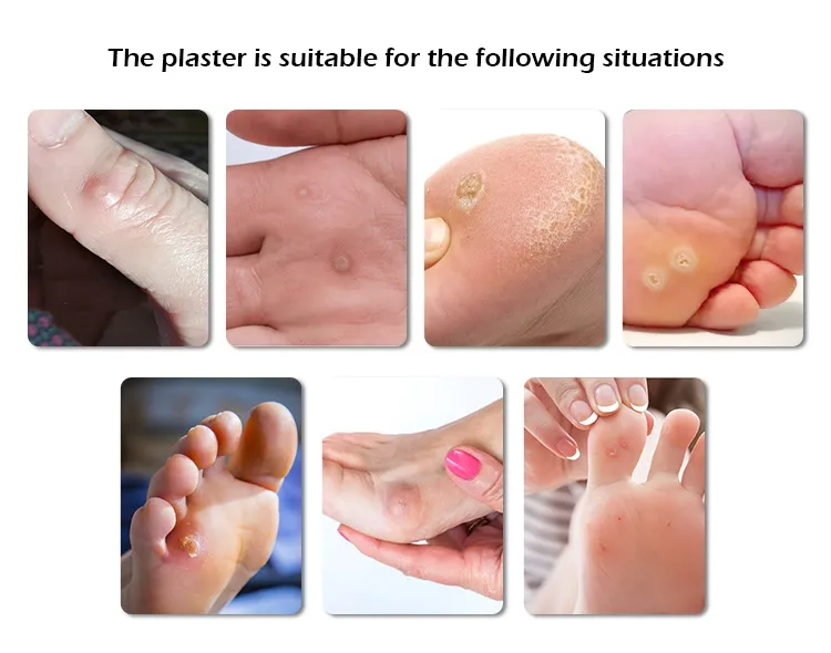 Wart Removal Plaster