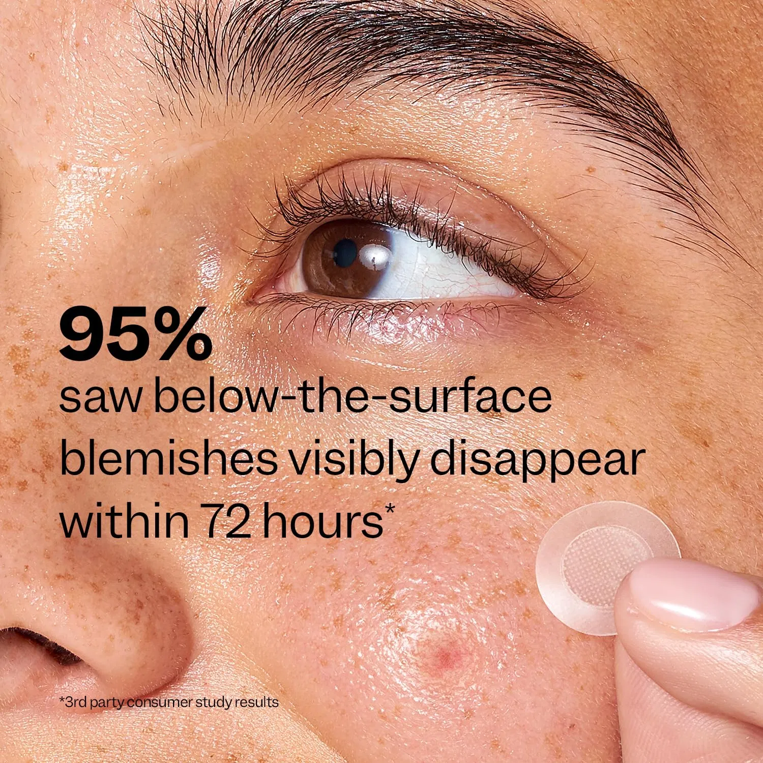 Deep Blemish Microdarts Acne Pimple Patch Fast-Acting Salicylic Acid Spot Treatment