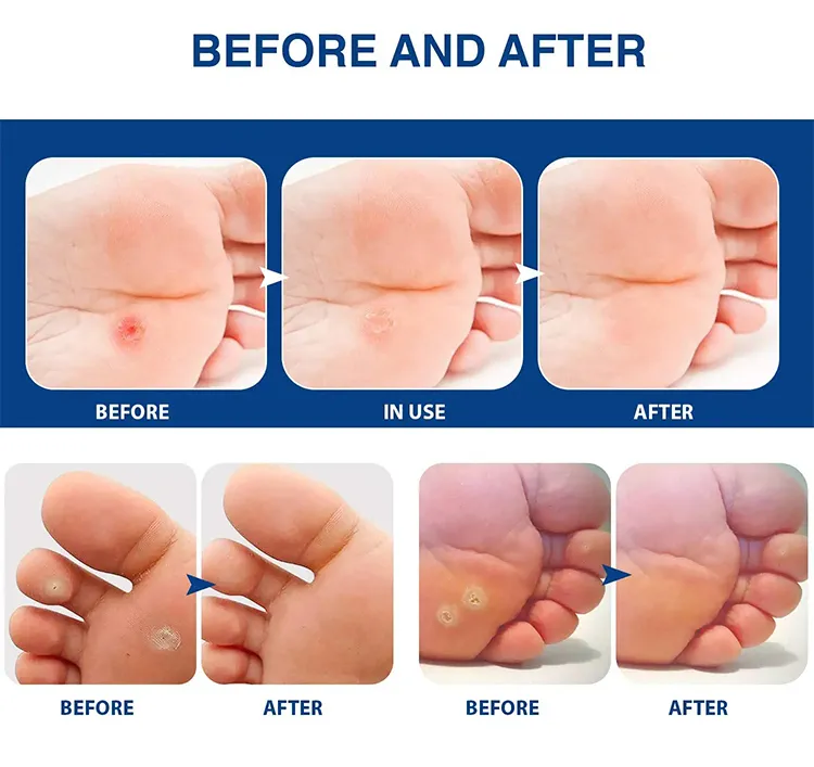 Corn Plaster Detail 8