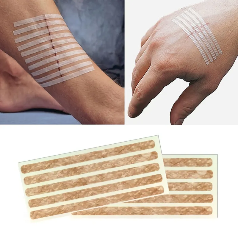 Wound Skin Closure 2