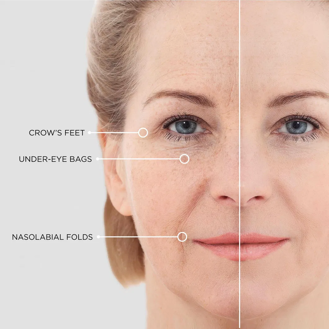 Microneedle Detail 4