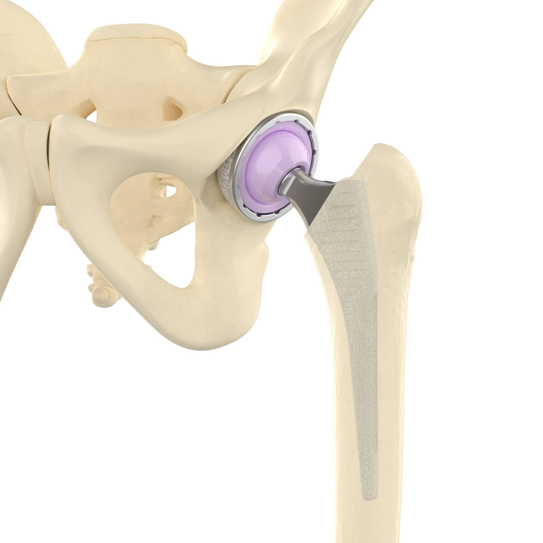 Canwell Primary Cemented Acetabular Cup UHMWPE Total Partial Hip Replacement Dual Mobility Arthroplasty Prosthesis Joint CE
