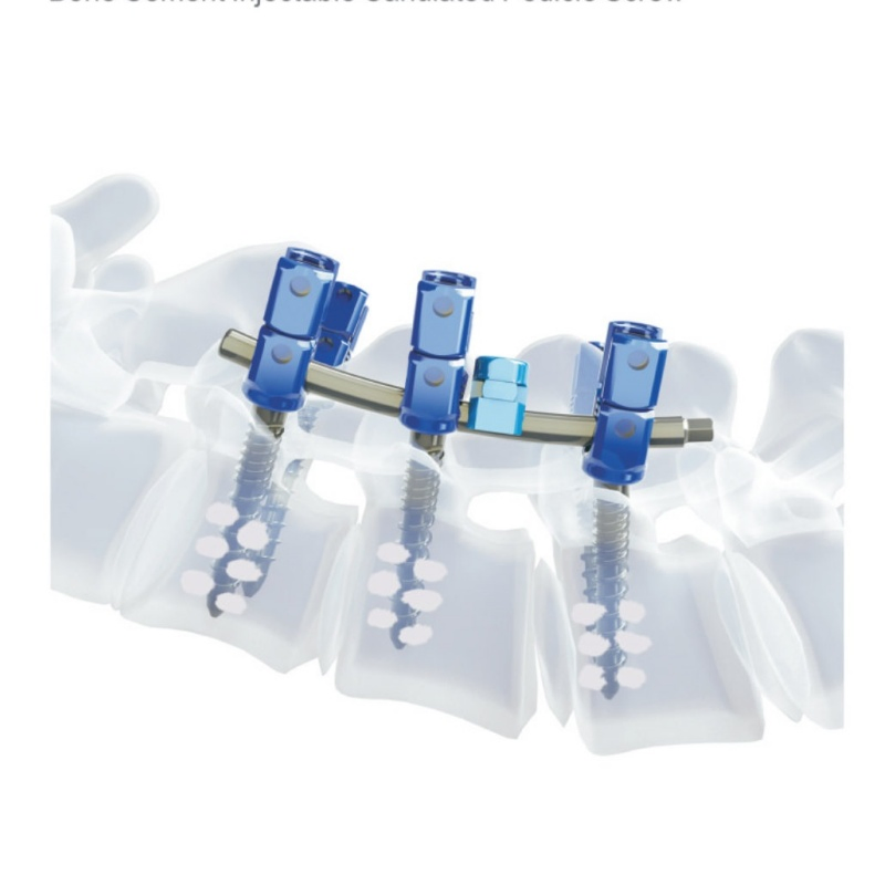 Medical Spine Bone Cement Cannulated Pedicle Screw
