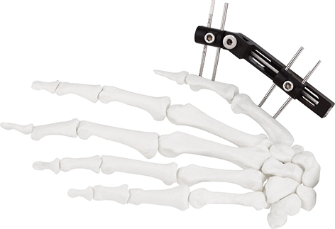 External Fixator Hand Bone Pin Stent Radius Mini Fixator Medical Equipment