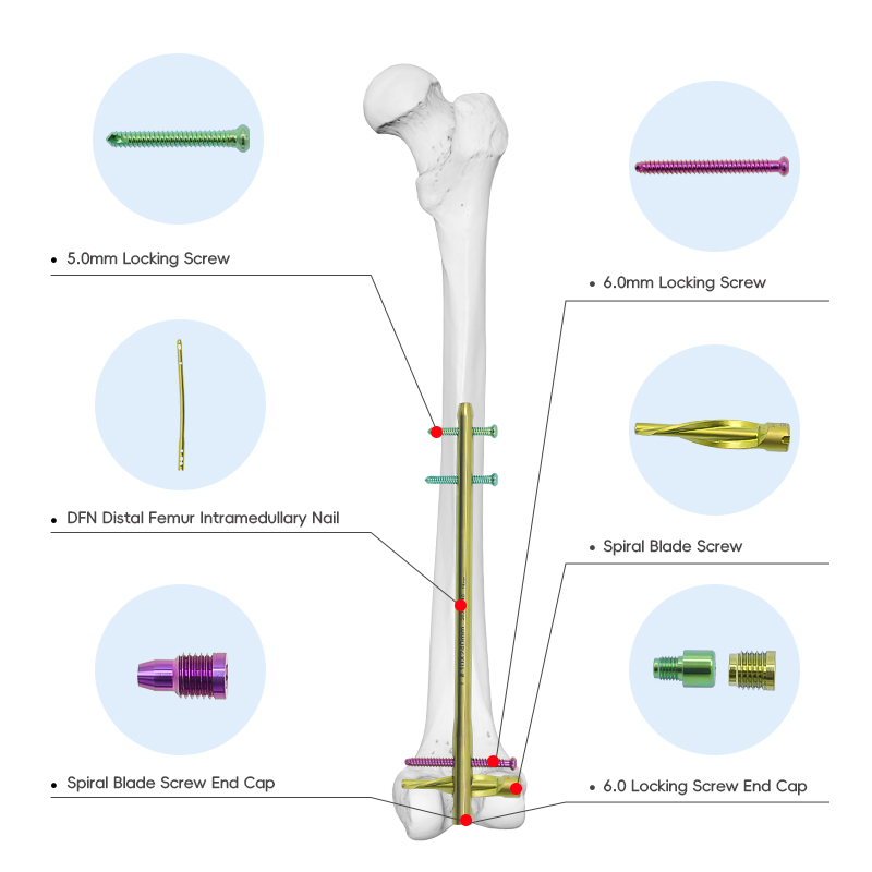 Medical Supply Orthopedic Implant Titanium Dfn Distal Femoral Intramedullary Nail