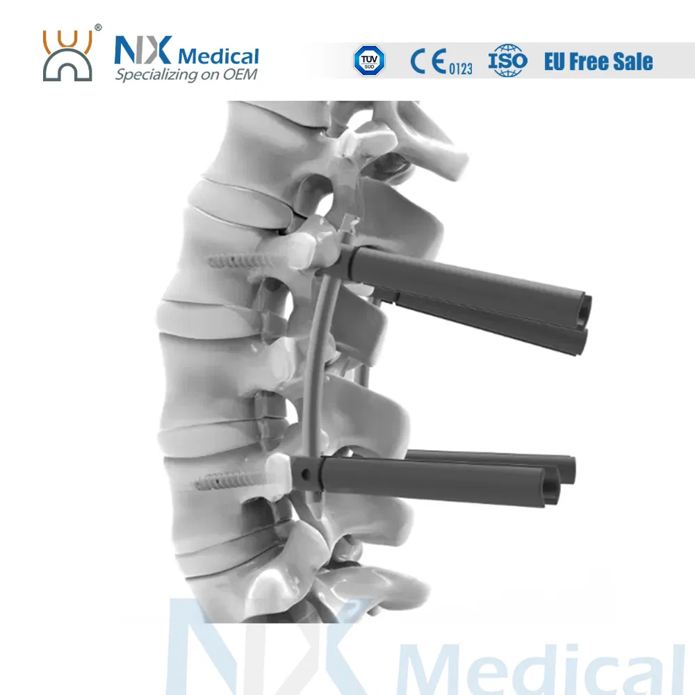 Nx Medical Spine Implant Titanium Cannulated Bone Cement Pedicle Screw