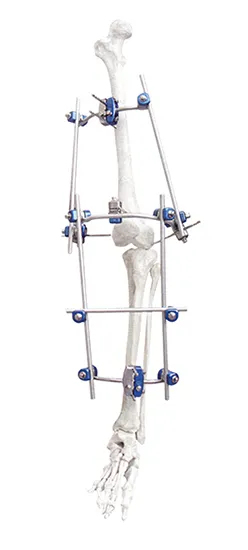 Knee Joint Fixator