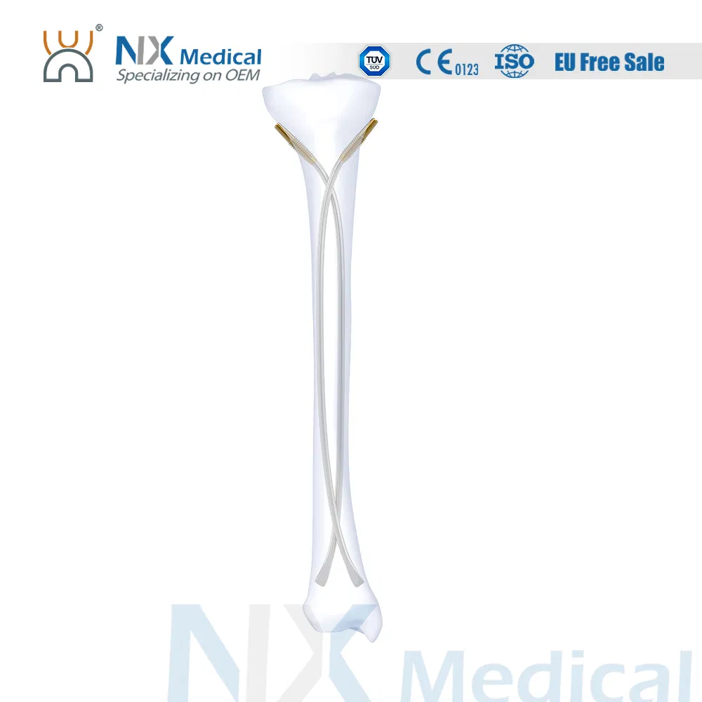 Nx Medical Orthopedic Implant Titanium Elastic Interlocking Intramedullary Nail Bone Fixation