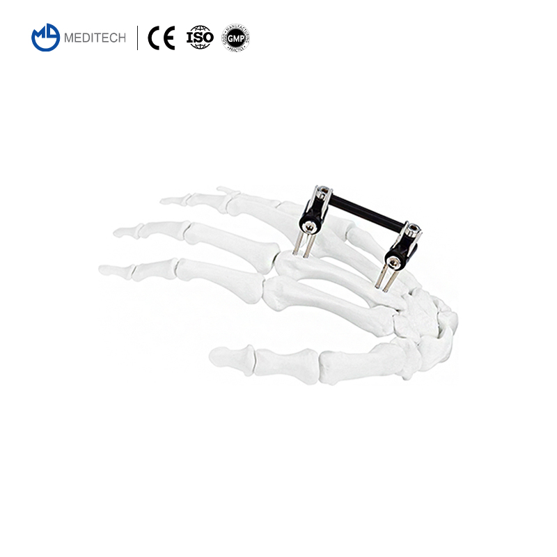 Meditech Mini Fixator Combined Type Orthopedic External Fixator Orthopedic Device Mini Finger and Palm Fixator