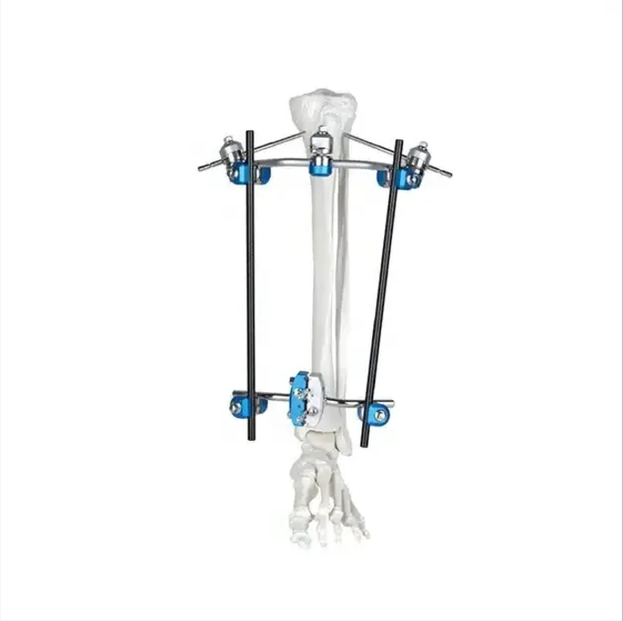 Customized External Fixation Device for Femoral Fracture Stent External Fixator System Orthopedic Surgery Instrument