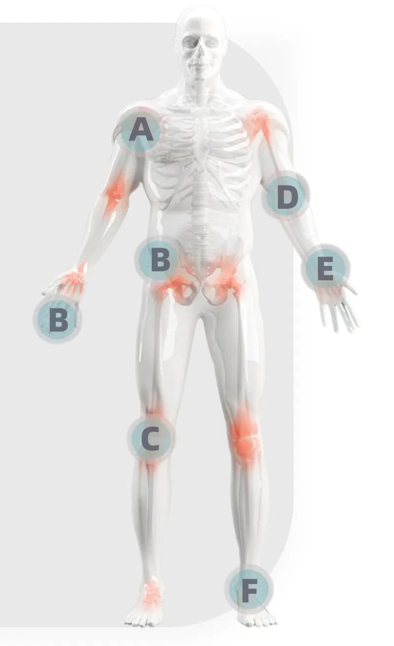 Medical Suture Anchor Components