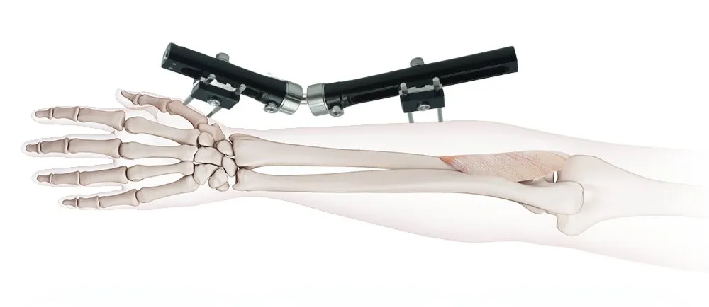 Wrist Fixator Detail