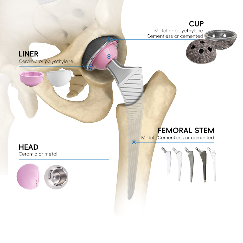 Total Hip and Knee Joint Replacement Metal Titanium Implant Made in China
