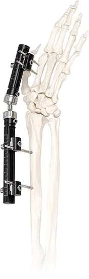 Common Straight Fixator