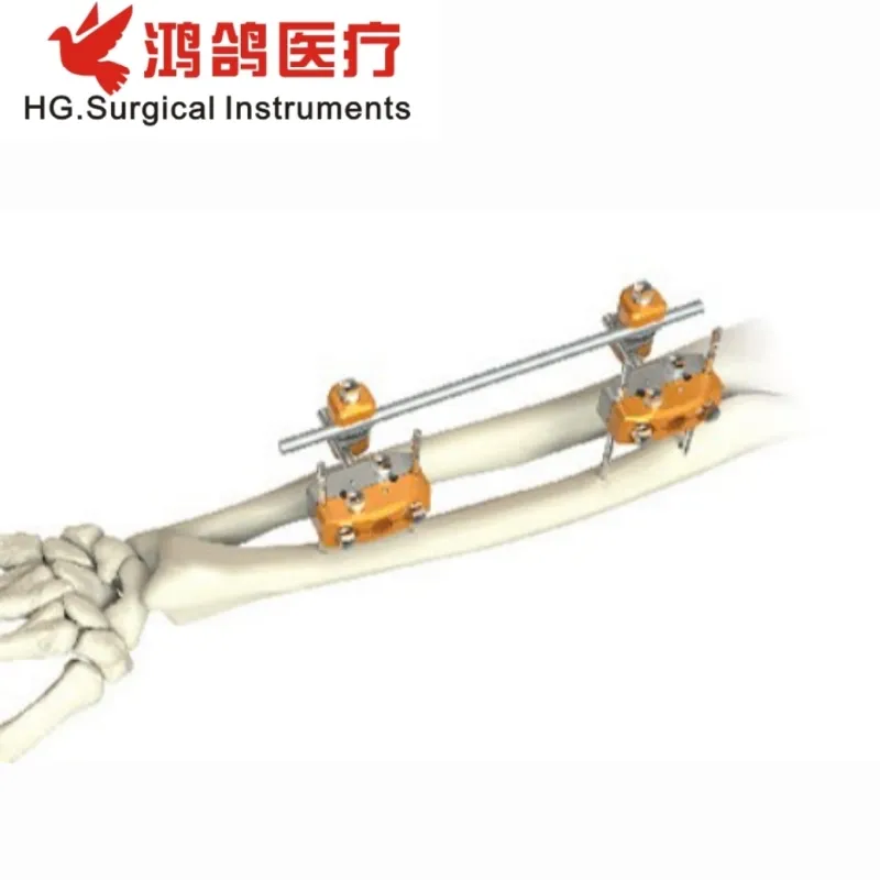 Orthopedic External Fixator 3