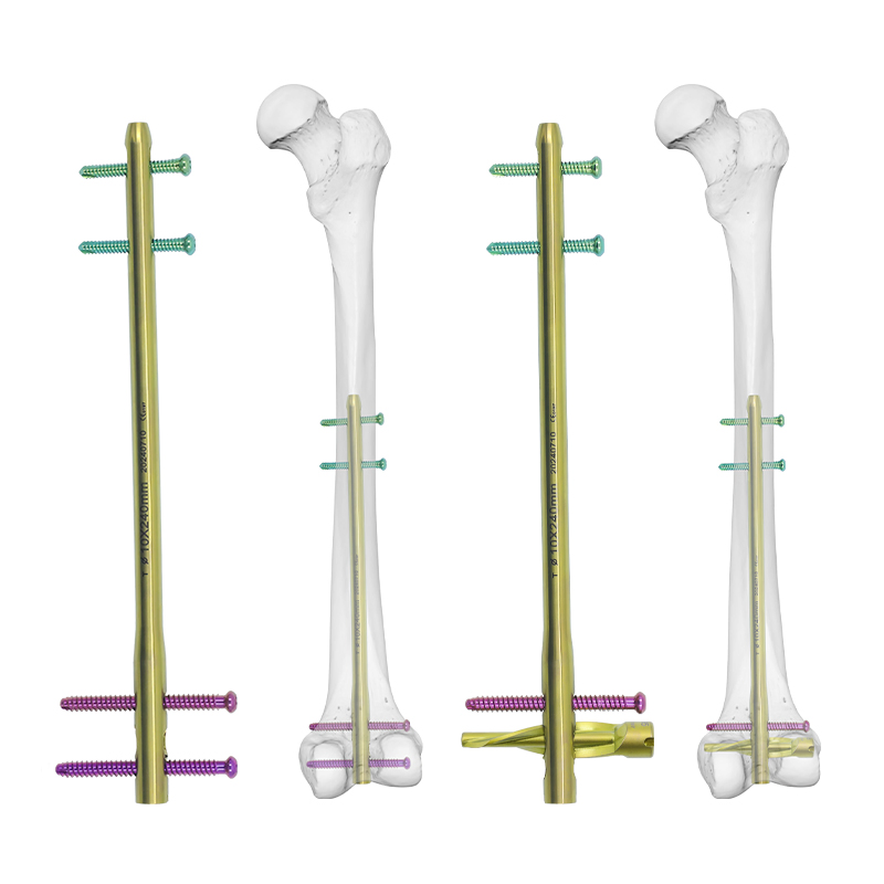 Medical Supply Orthopedic Implant Titanium Dfn Distal Femoral Intramedullary Nail