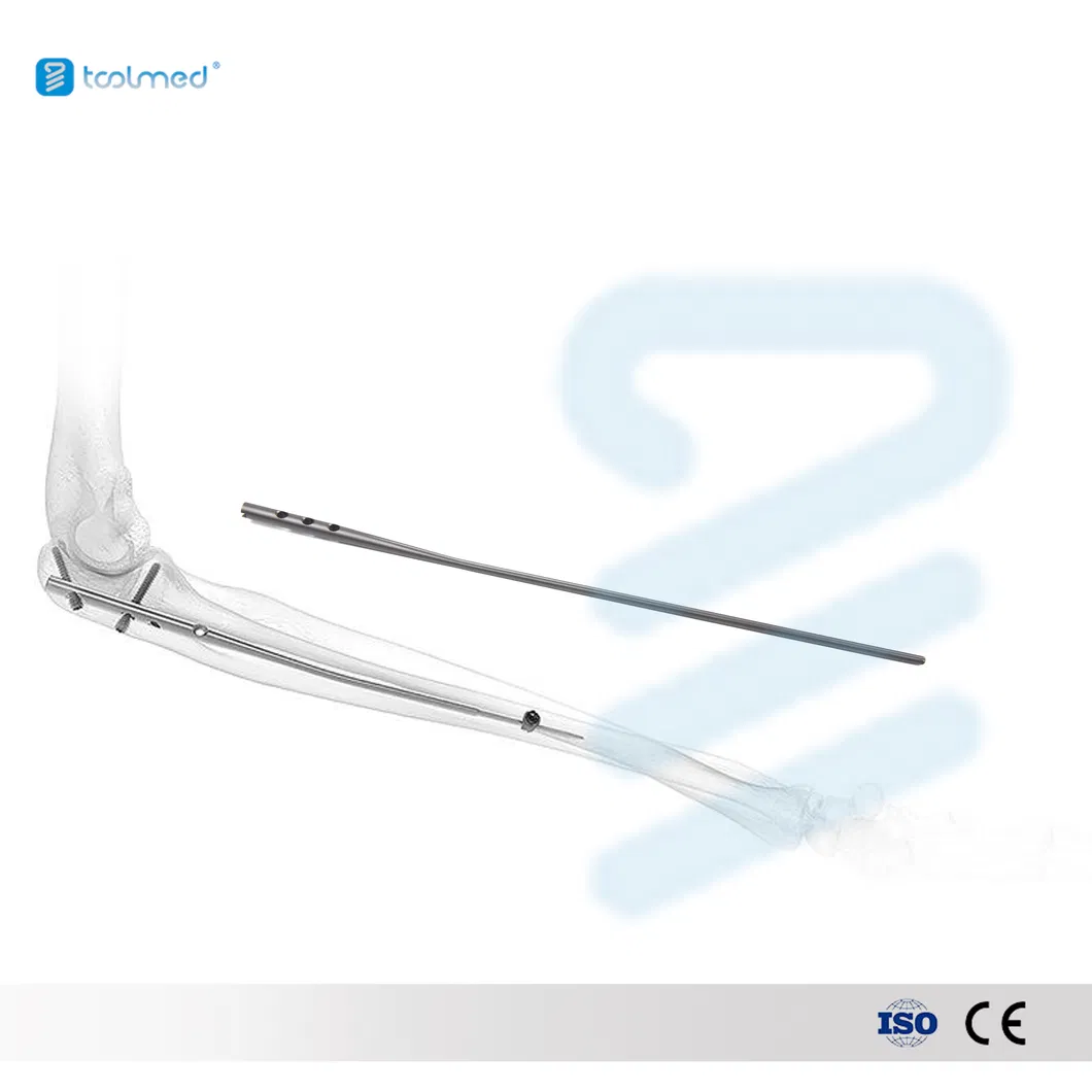 Ulna Radius Intramedullary Nail