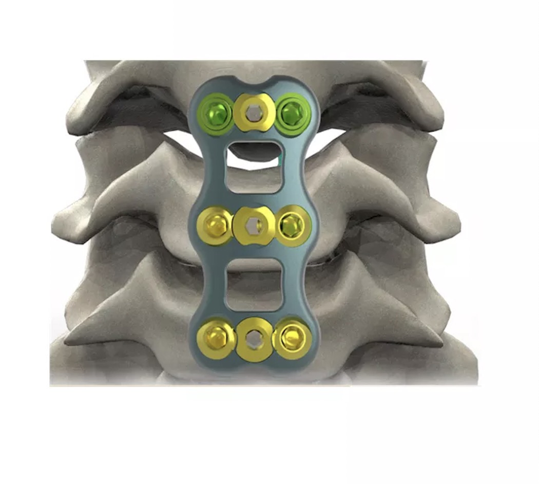 Anterior Cervical Fixation System with Screw for Cervical Spine with CE Certificate