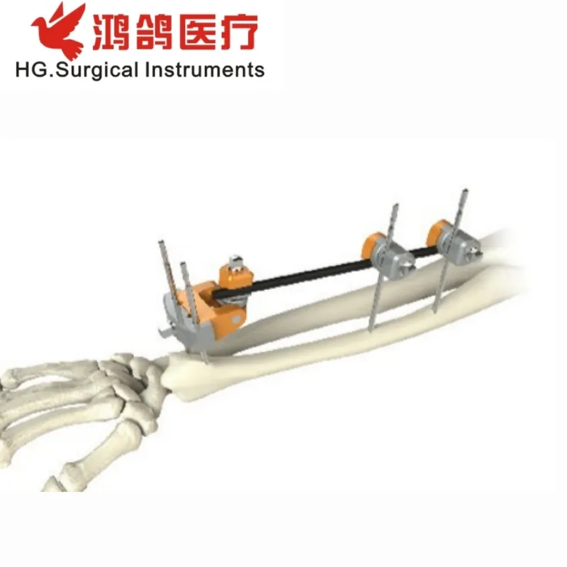 Orthopedic External Fixator 1