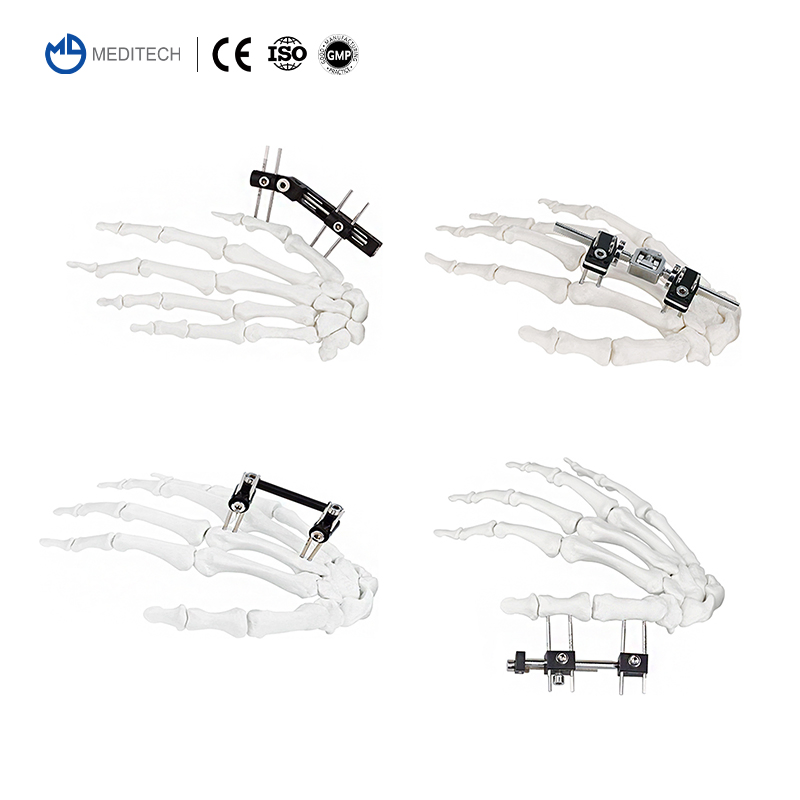 Meditech Mini Fixator Combined Type Orthopedic External Fixator Orthopedic Device Mini Finger and Palm Fixator