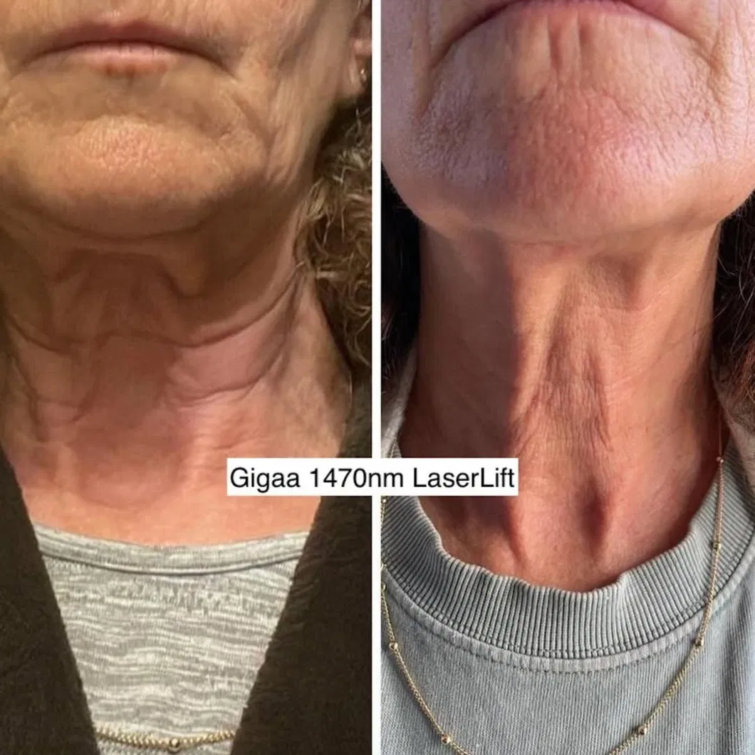 Before and After Treatment Result 1