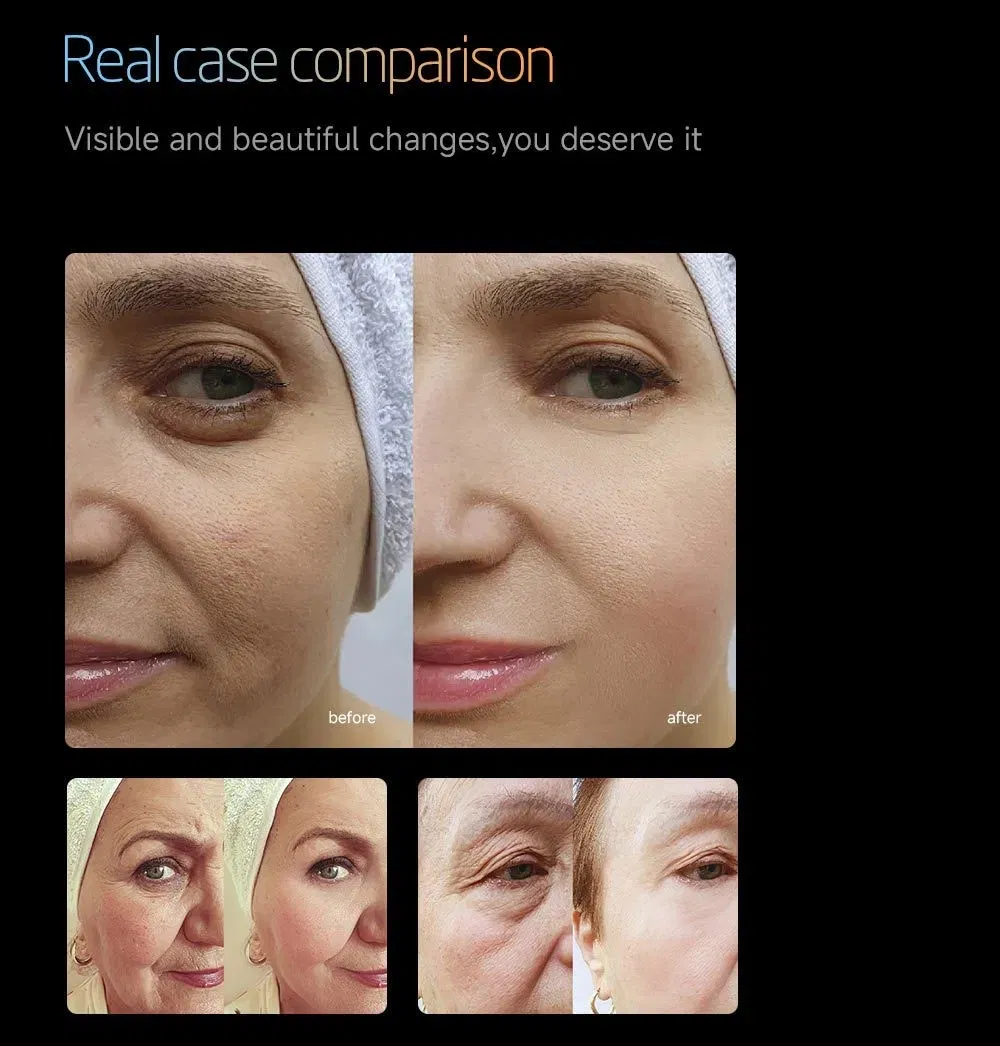 Hifu Before and After Results