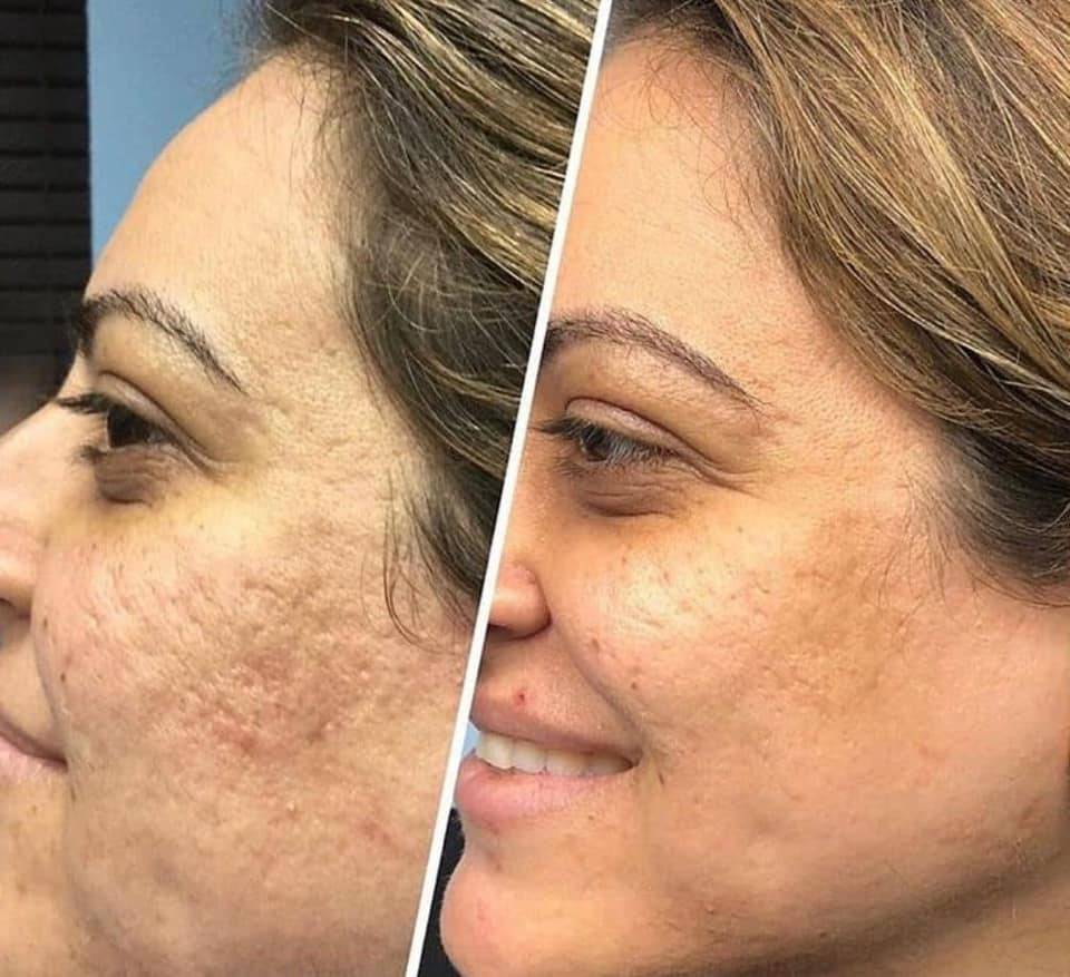 High-Performance Secret RF Microneedling System for Youthful Skin
