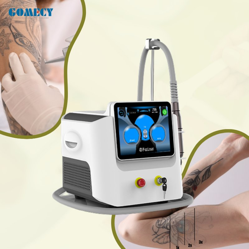 Advanced ND YAG Laser System for Carbon Peeling and Acne Treatment