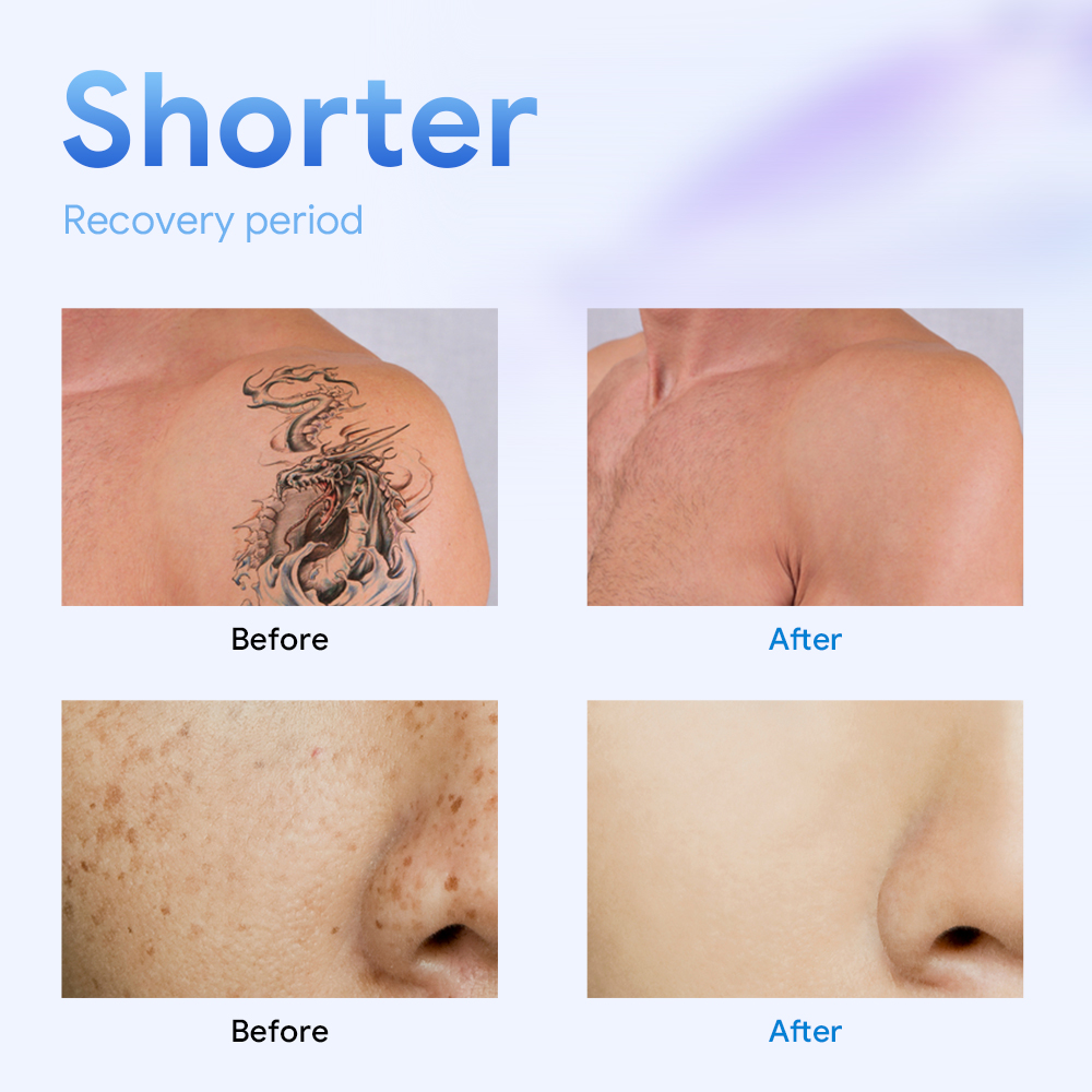 MDR Certified 1064nm&532nm Picosecond Qswitch ND Yag Laser/ QSwitch Nd YAG Q Switch Nd Yag Laser for Tattoo Removal