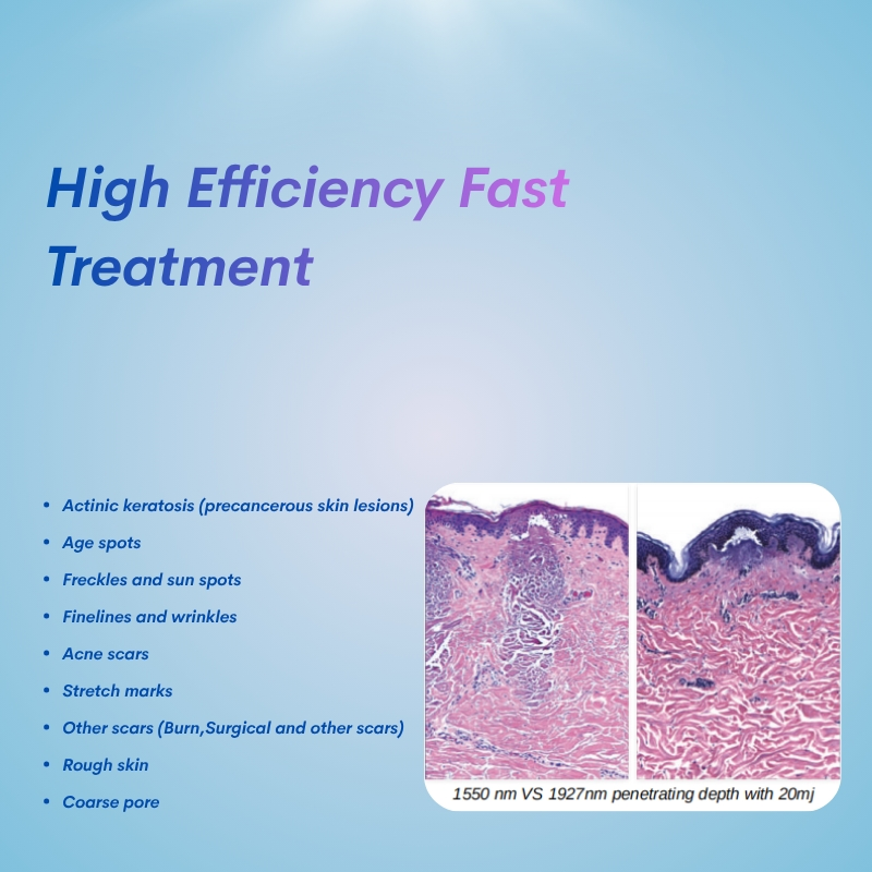 Melasma Treatment Fractional Laser System Skin Texture Improvement Laser Device Manufacturer