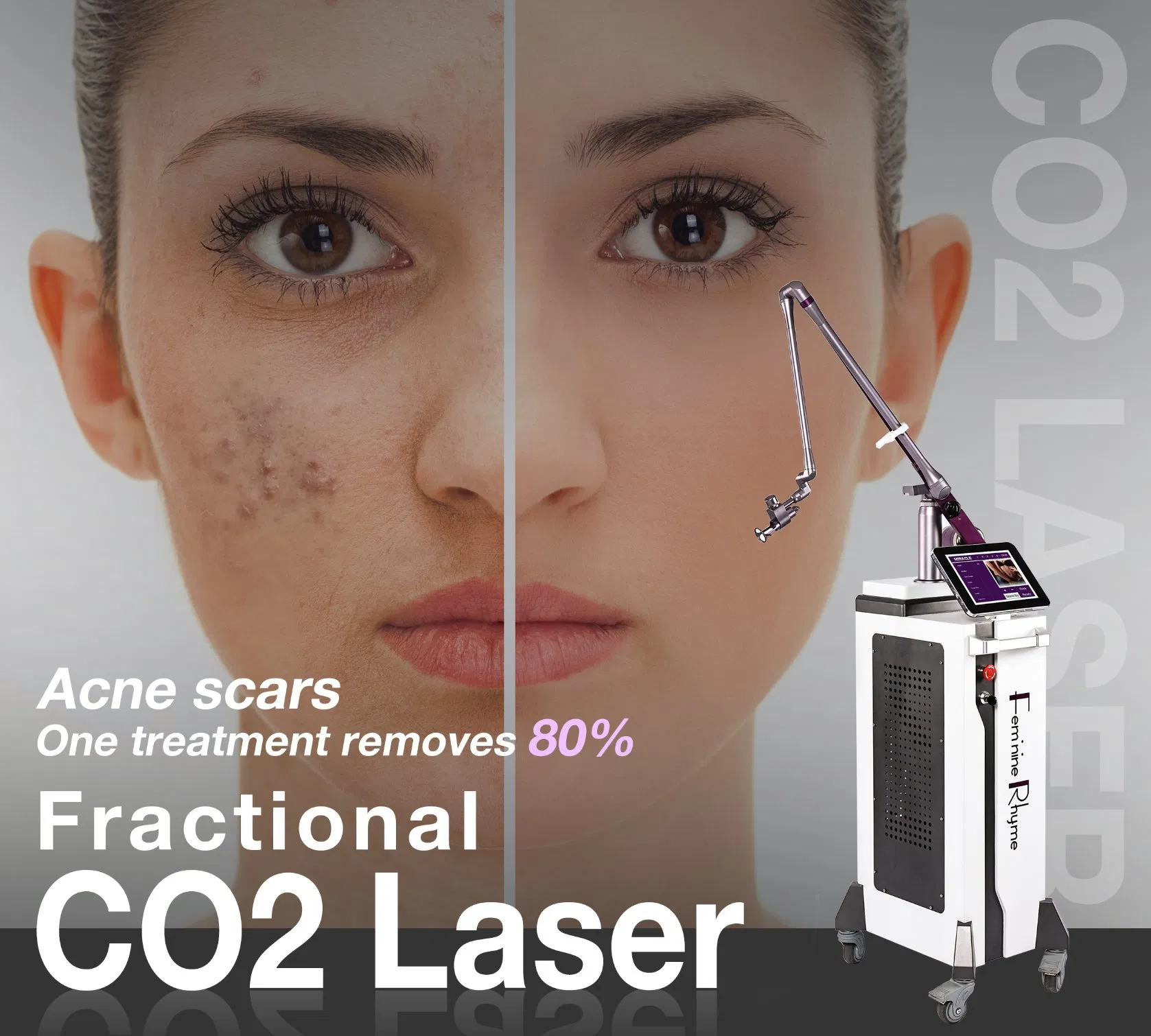 Advanced Pixel CO2 Laser System for Dermatology Treatments