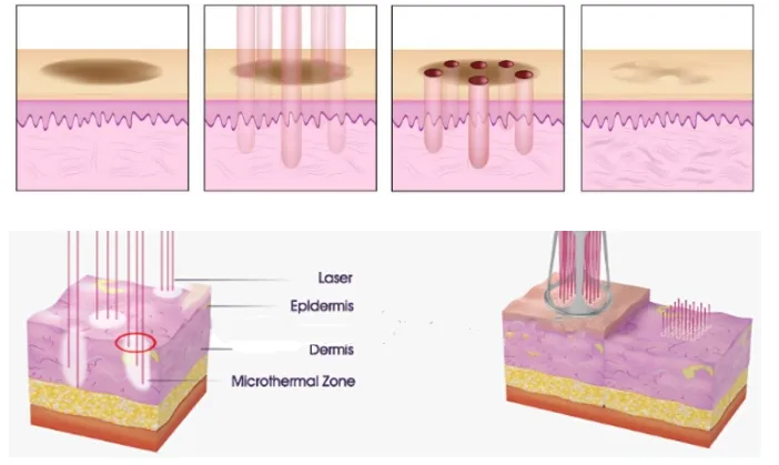 Laser Working Principle