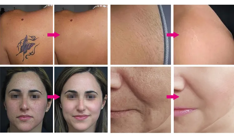 Before and After