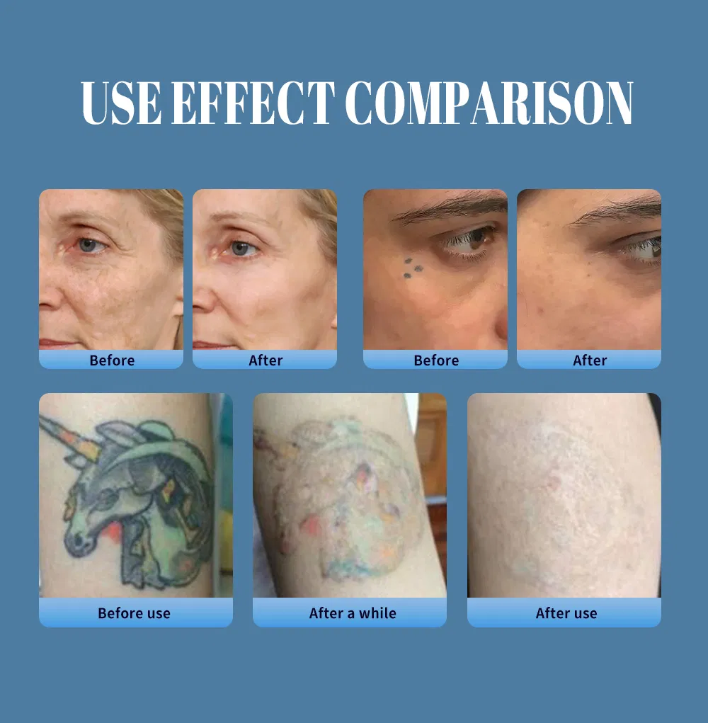 ND YAG Laser Features