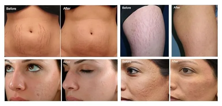 Before and After Results